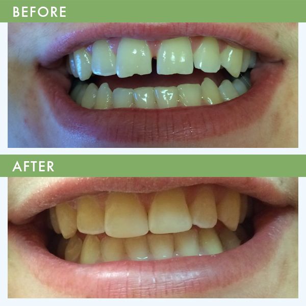 Composite Tooth Bonding Cosmetic Dentistry Louisville KY