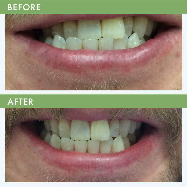 Inman Aligner teeth Straightening Louisville KY