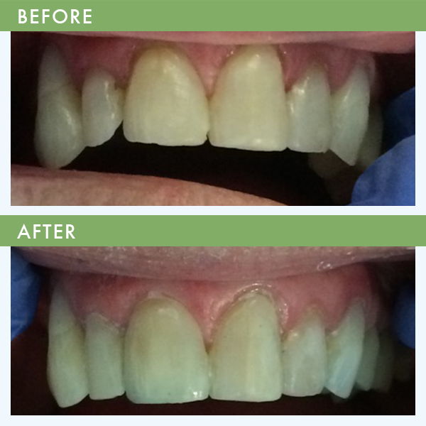 Front Tooth Bonding Cosmetic Dentistry Louisville KY