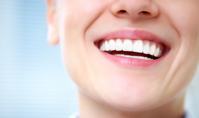 Up close perfectly straight, bright smile thanks to Lumineers veneers