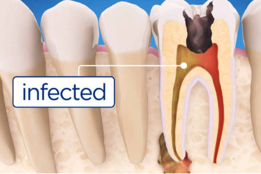 illustration of an infected tooth needing root canal therapy