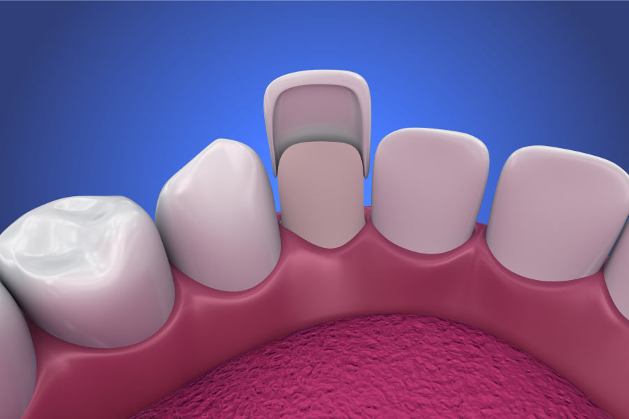 model of the porcelain veneers process