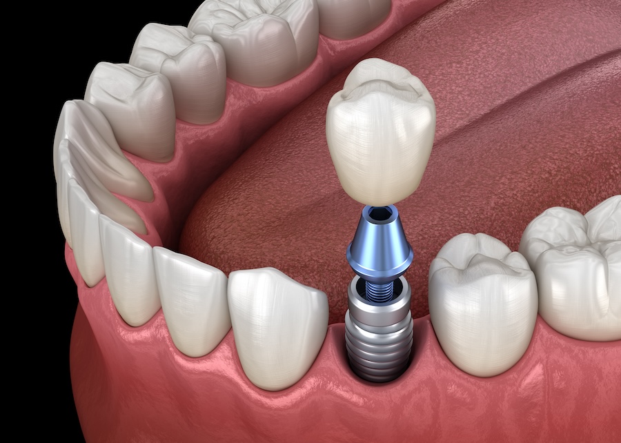 dental implants, 3D imaging, guided implant surgery, immediate implants, nanotechnology, smart implants, All-on-4, All-on-6, Springhurst Hills Dentistry, dentist in Louisville, Dr. Lan Tran