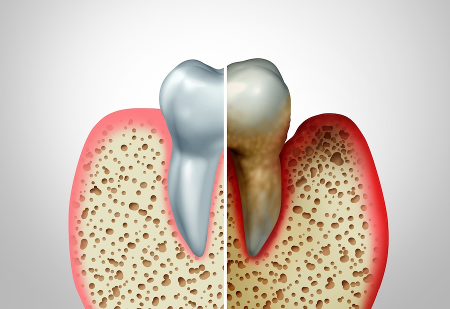 stages of gum disease, gum disease treatment, gingivitis, periodontitis, dentist in Louisville KY, Springhurst Hills Dentistry, gum health, dental care, gum disease prevention