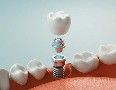 illustration of a dental implant