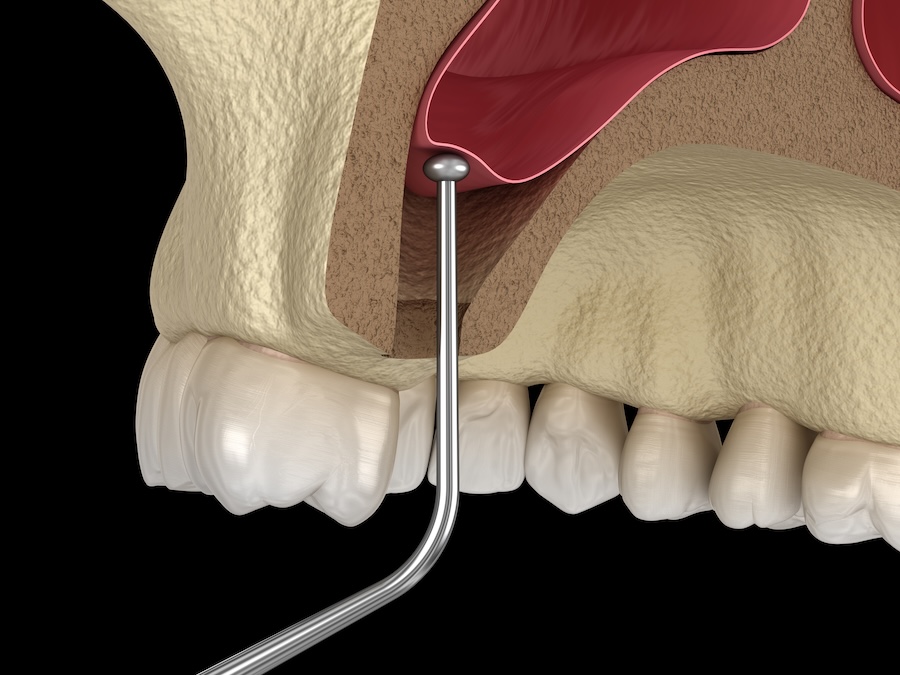 sinus lift surgery for dental implant placement