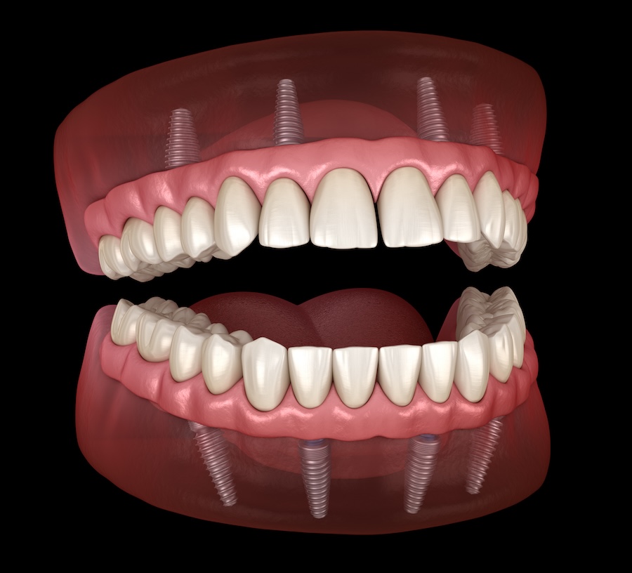 full mouth dental implants or implant supported dentures