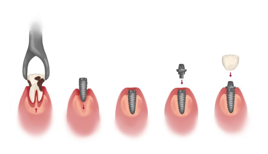 dental implant timeline