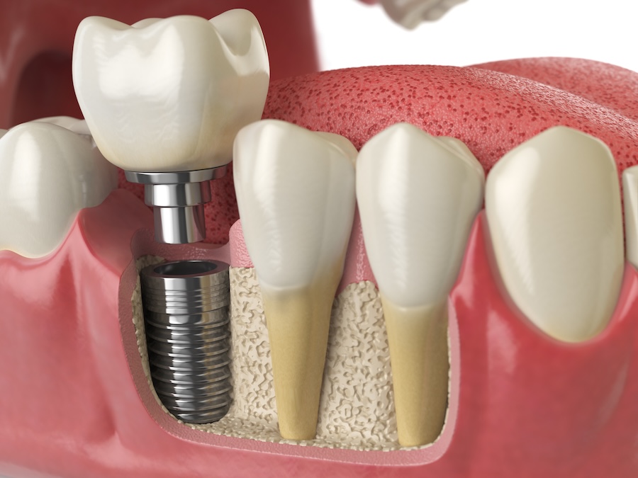 dental implant in mouth to restore chewing power